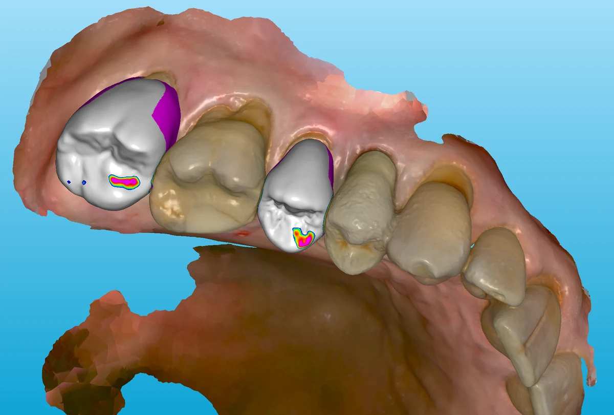 Digital restoration design software showing crowns and contact map