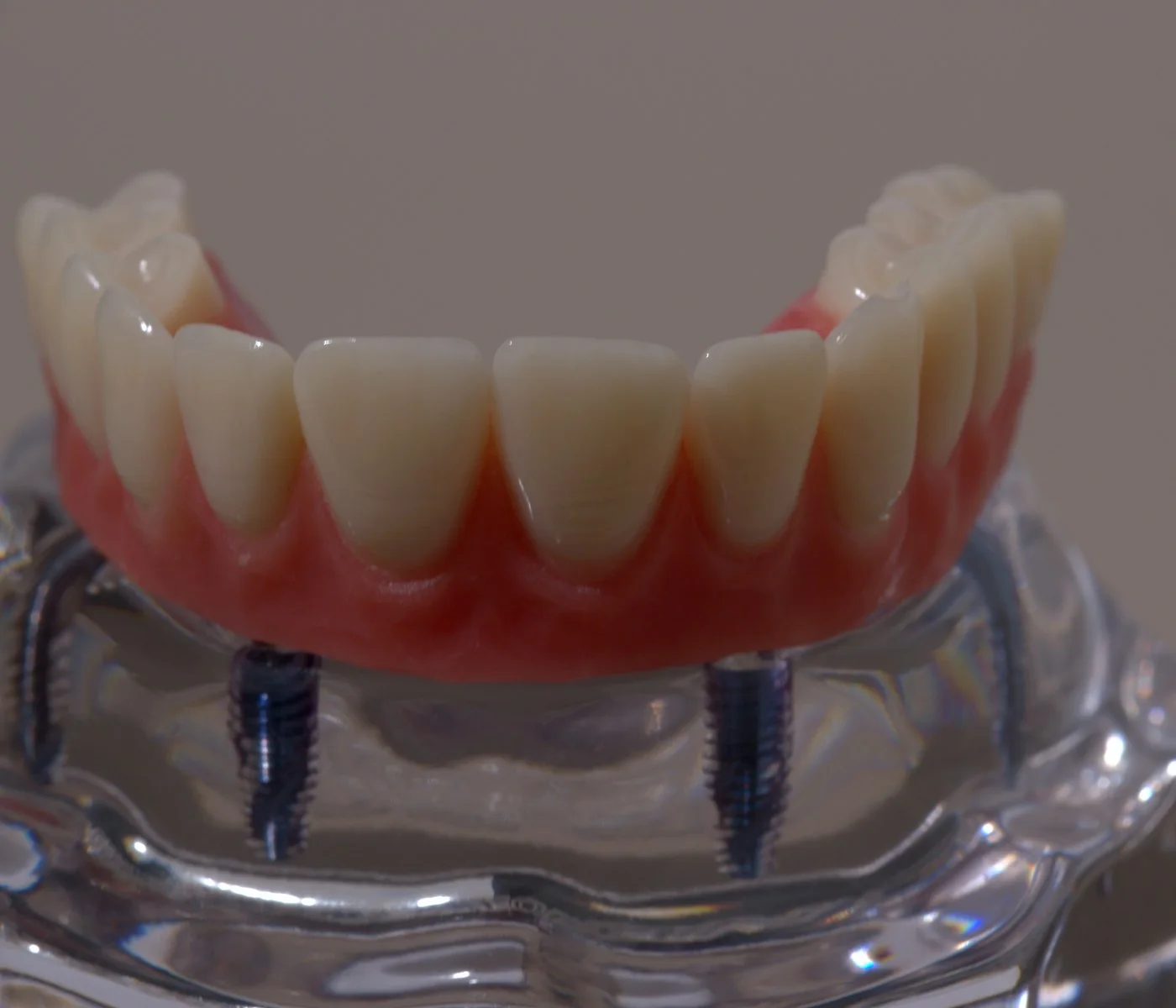All-on-X full arch on a clear model showing the supporting implants — Smile Spot Dentistry, Venice, FL