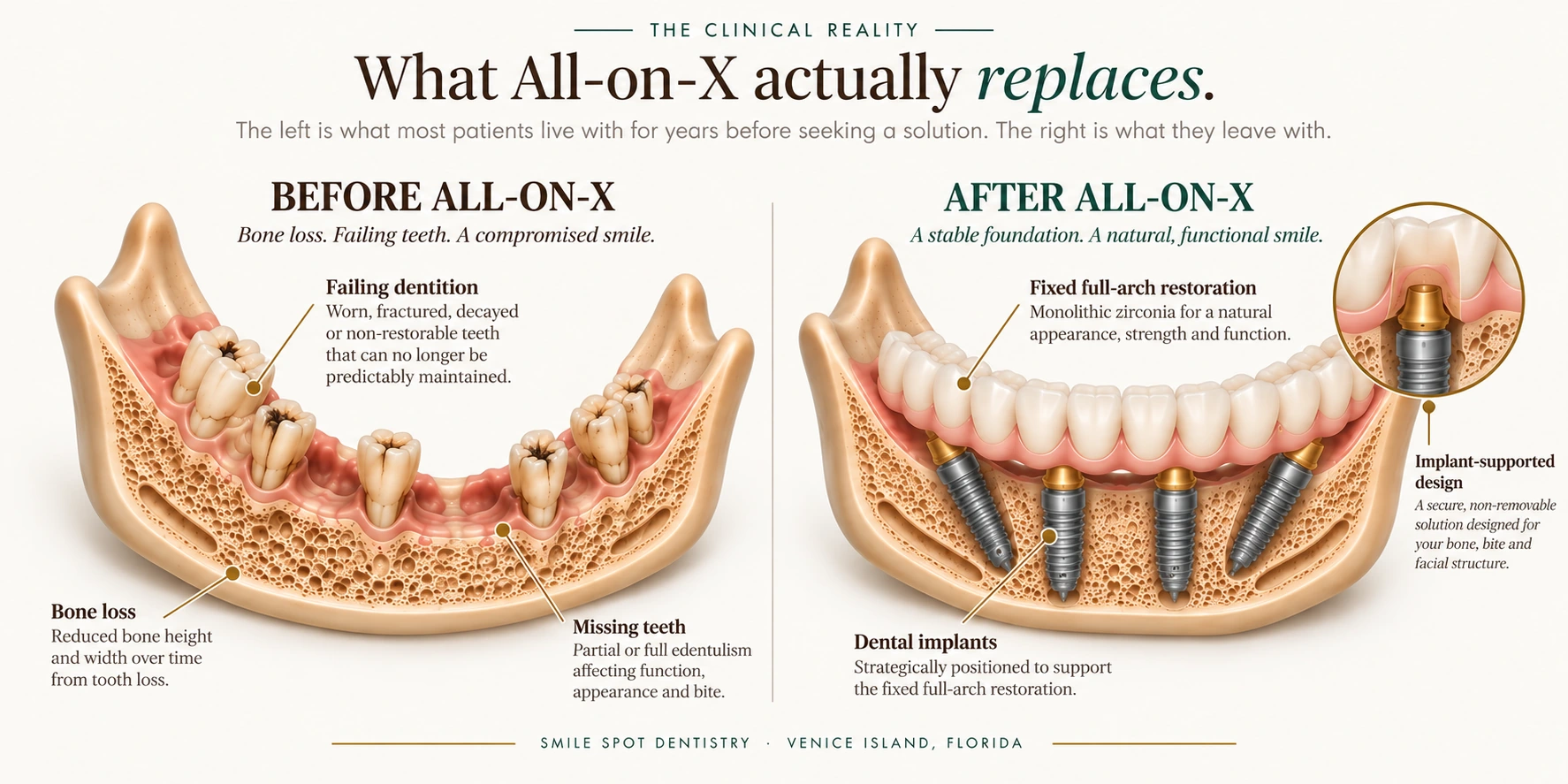 Before and after All-on-X — failing dentition, missing teeth and reduced bone height compared with a fixed monolithic zirconia full-arch restoration on four implants — Smile Spot Dentistry, Venice, FL