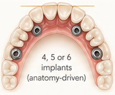 Bespoke implant count — All-on-X at Smile Spot Dentistry, Venice, FL