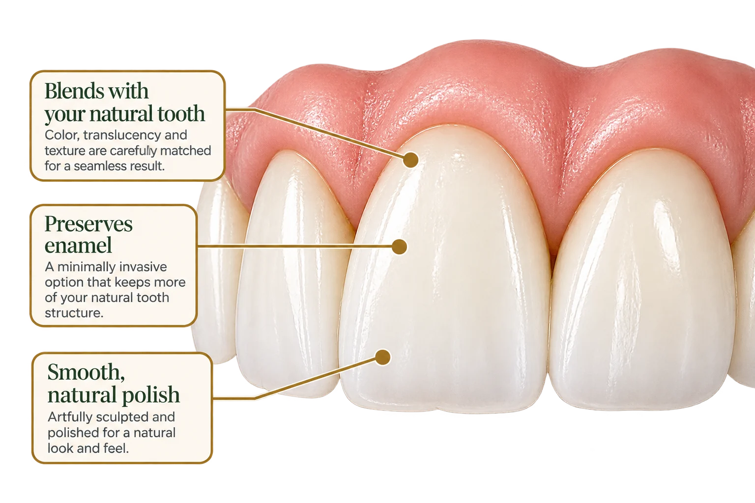 Close-up of bonded front teeth labelled: blends with your natural tooth — color, translucency and texture matched; preserves enamel — a minimally invasive option; smooth, natural polish — artfully sculpted and polished