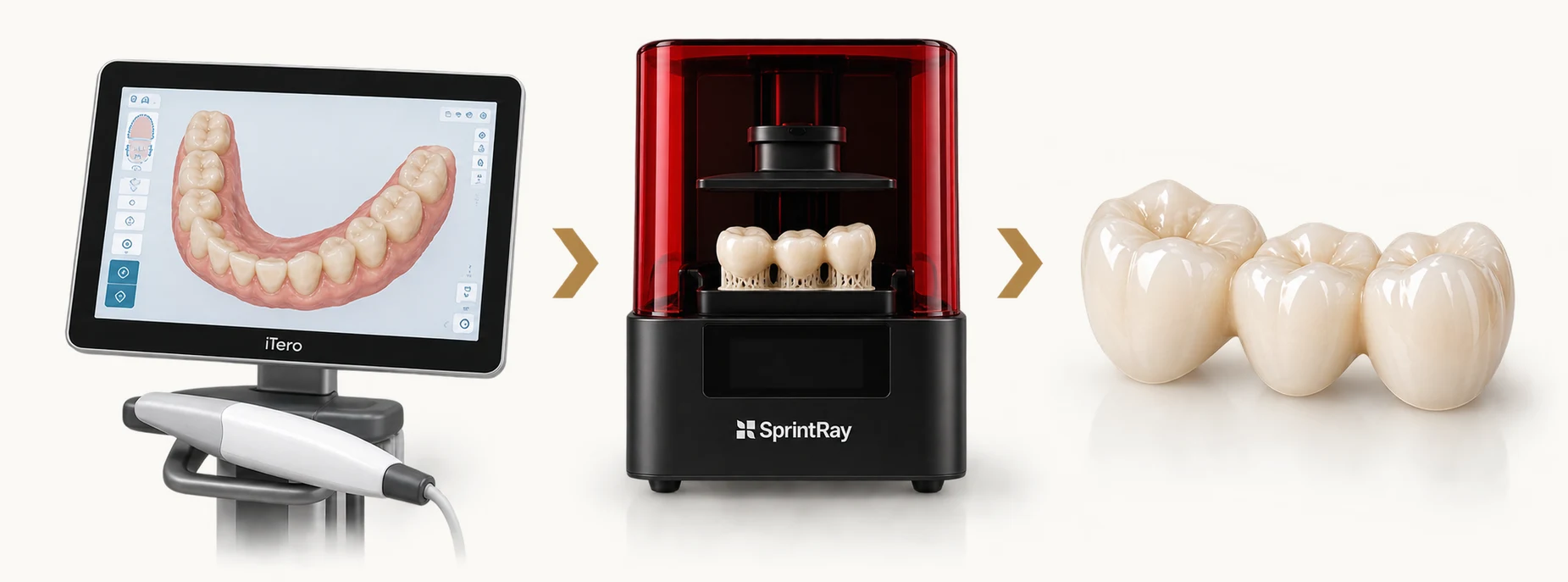 Digital bridge workflow at Smile Spot Dentistry, Venice FL — iTero intraoral scan, a provisional bridge printed in-office on the SprintRay printer, and the finished ceramic bridge