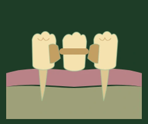 Maryland bonded bridge — a single pontic with thin wings bonded to the back of unprepared adjacent teeth — Smile Spot Dentistry, Venice FL