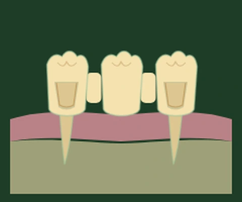 Traditional three-unit fixed bridge — two prepared abutment teeth with crowns supporting a pontic between them — Smile Spot Dentistry, Venice FL