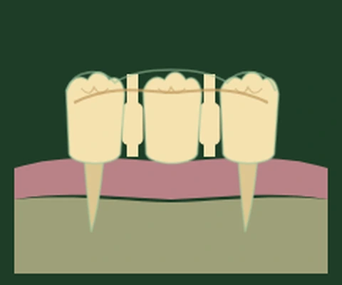 Monolithic zirconia bridge — a single milled ceramic span rather than separate connected units — Smile Spot Dentistry, Venice FL