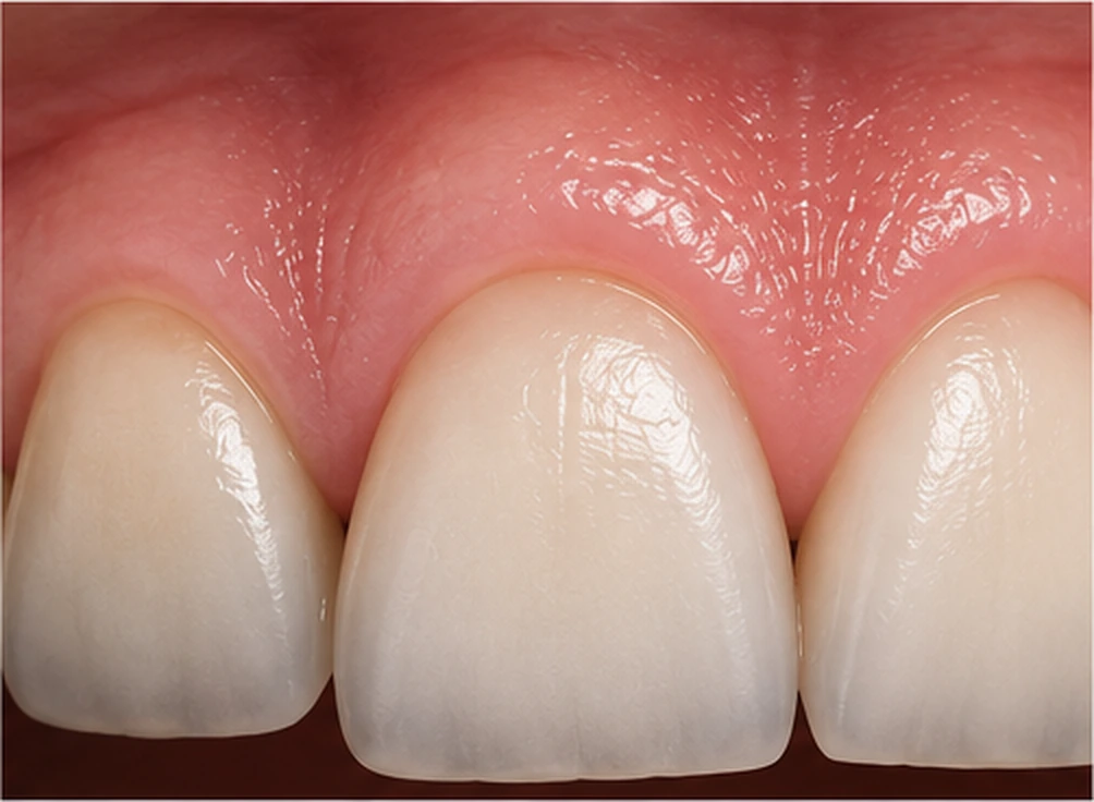 Gum health — Smile Spot Dentistry, Venice, FL