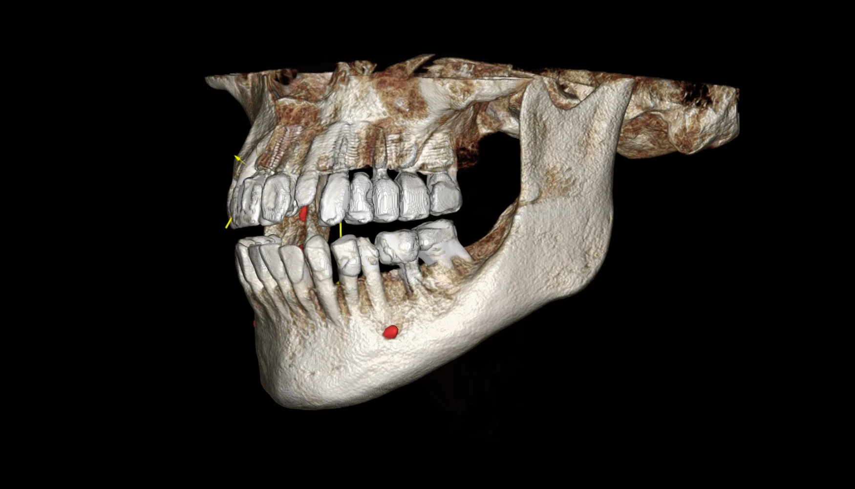 Vision 16 CBCT 3D reconstruction of the jaws, teeth and bone