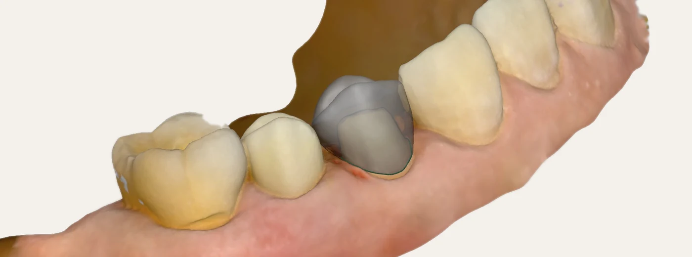 Crown margin traced digitally on the 3D scan in restoration design software — Smile Spot Dentistry, Venice FL
