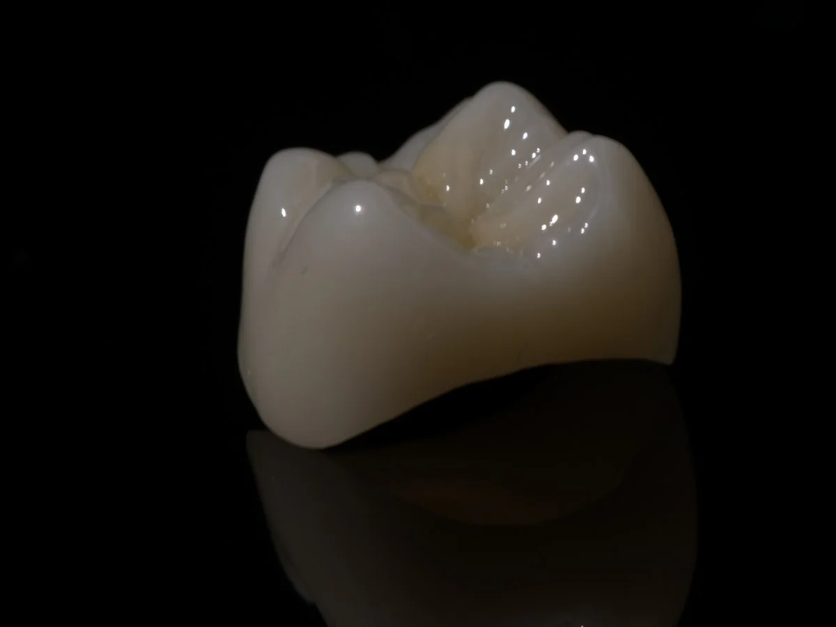 Final ceramic crown checked before bonding — Smile Spot Dentistry, Venice FL