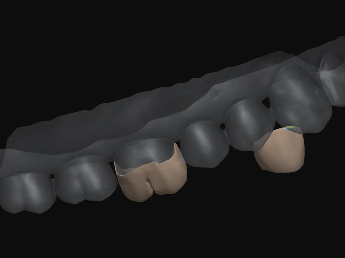 Same-day crowns designed in SprintRay software on the digital scan — Smile Spot Dentistry, Venice FL