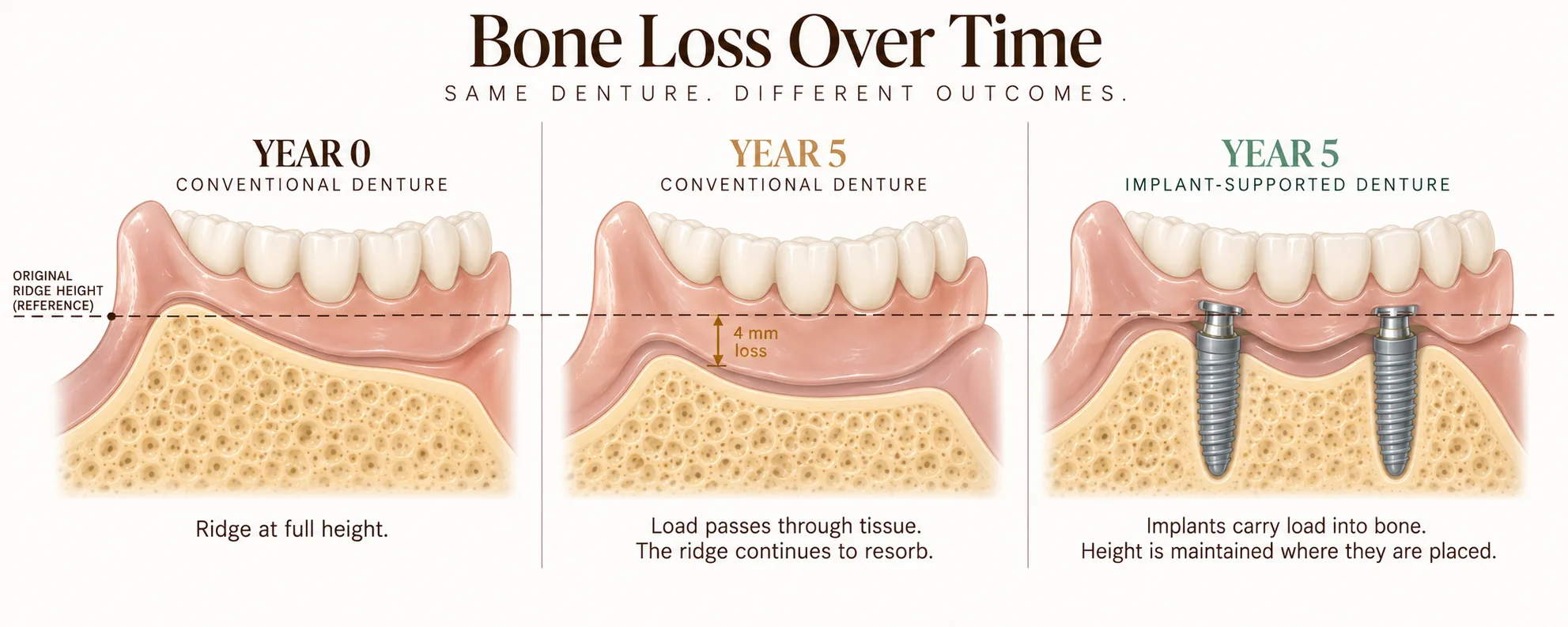 Three-panel cross-section of the lower ridge over time, measured against a dashed line marking the original ridge height. At Year 0 the bone meets that line beneath a conventional denture. At Year 5 with a conventional denture the ridge has resorbed roughly 4mm below it. At Year 5 with an implant-supported denture the bone is held near the original height at each implant site, with mild loss between them. Smile Spot Dentistry, Venice FL.