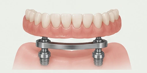 Bar-retained overdenture connected to a custom bar joining multiple implants — Smile Spot Dentistry, Venice FL