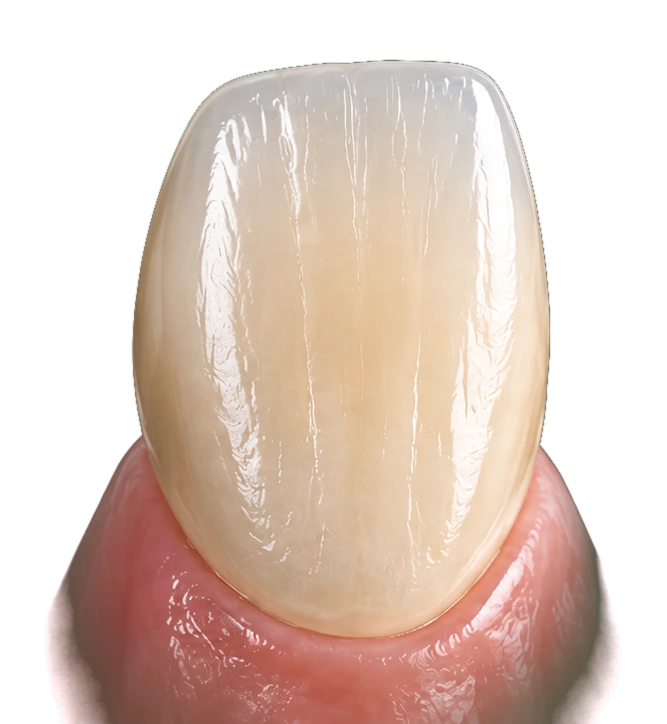 A natural upper central incisor with intact enamel — Smile Spot Dentistry, Venice, FL