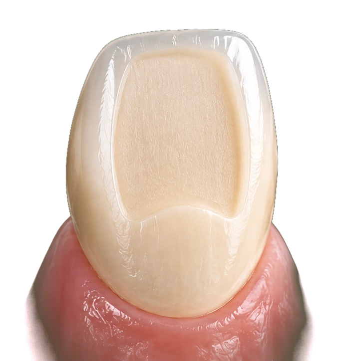 The same tooth after a thin, conservative facial reduction — Smile Spot Dentistry, Venice, FL