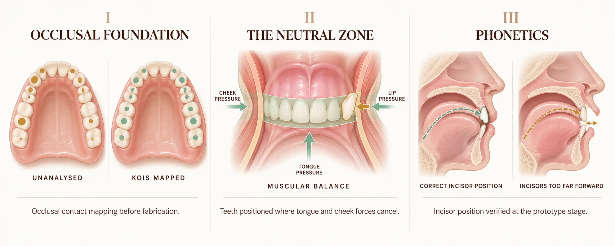 Three functional protocols applied before a denture is fabricated. Occlusal foundation: an unanalysed arch with uneven scattered contacts beside a Kois-mapped arch with contacts distributed evenly. The neutral zone: tongue, cheek and lip pressure meeting in balance, with the teeth set inside the zone where those forces cancel and one tooth shown displaced outside it. Phonetics: the tongue path for the S sound reaching the incisors when they are correctly positioned, and falling short when they are set too far forward. Smile Spot Dentistry, Venice FL.