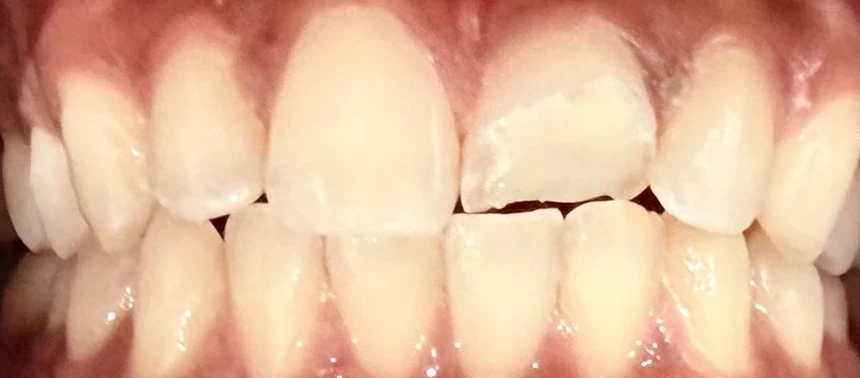 Before: retracted view showing a fractured incisal edge on an upper front tooth.