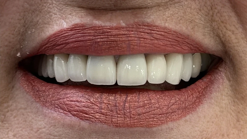 After: twelve layered zirconia crowns across the upper front teeth, even in contour.