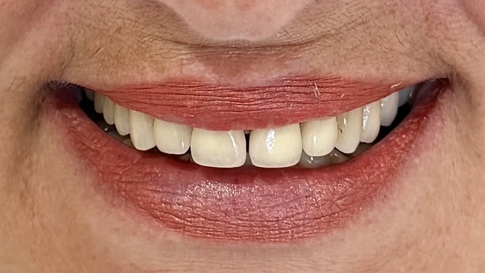 Before: aging porcelain-fused-to-metal crowns across the upper front teeth, uneven in shape and shade.
