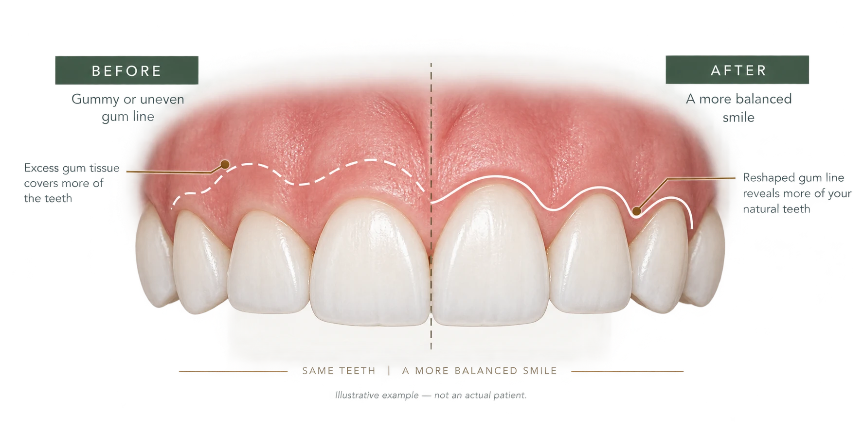 Illustration comparing a gummy, uneven gum line with excess tissue covering the teeth (before) and a reshaped, balanced gum line revealing more of the natural teeth (after). Illustrative example — not an actual patient.
