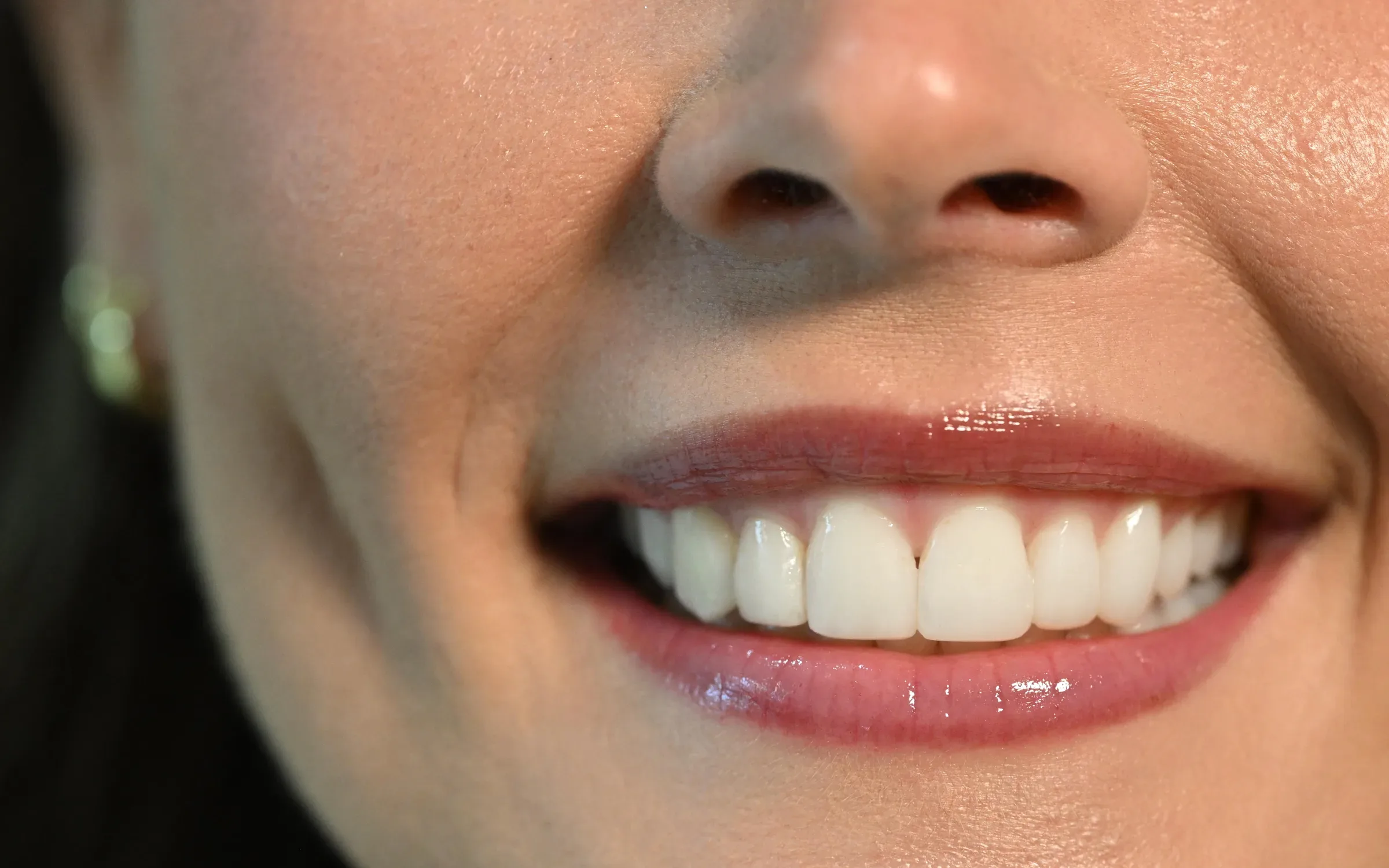 Balanced, even smile after gum contouring at Smile Spot Dentistry in Venice, FL
