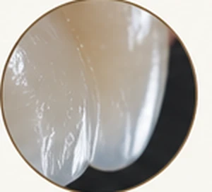 Light passing through translucent enamel at the incisal edge — Smile Spot Dentistry, Venice FL