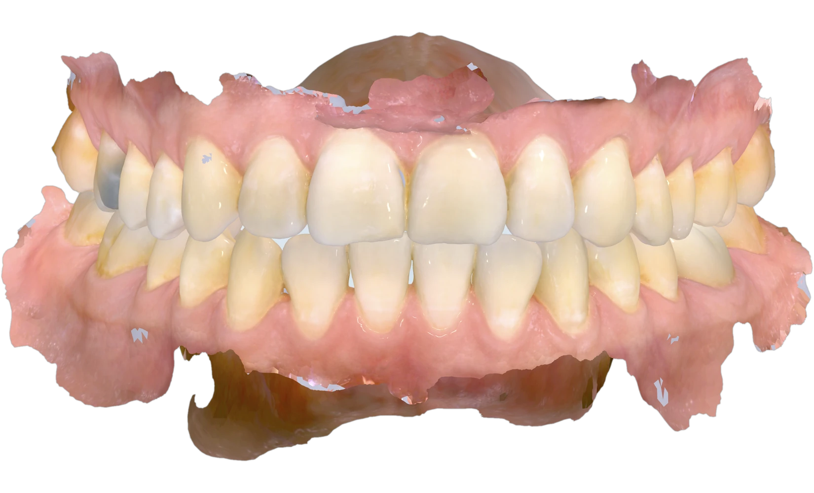 iTero digital 3D model of upper and lower dental arches