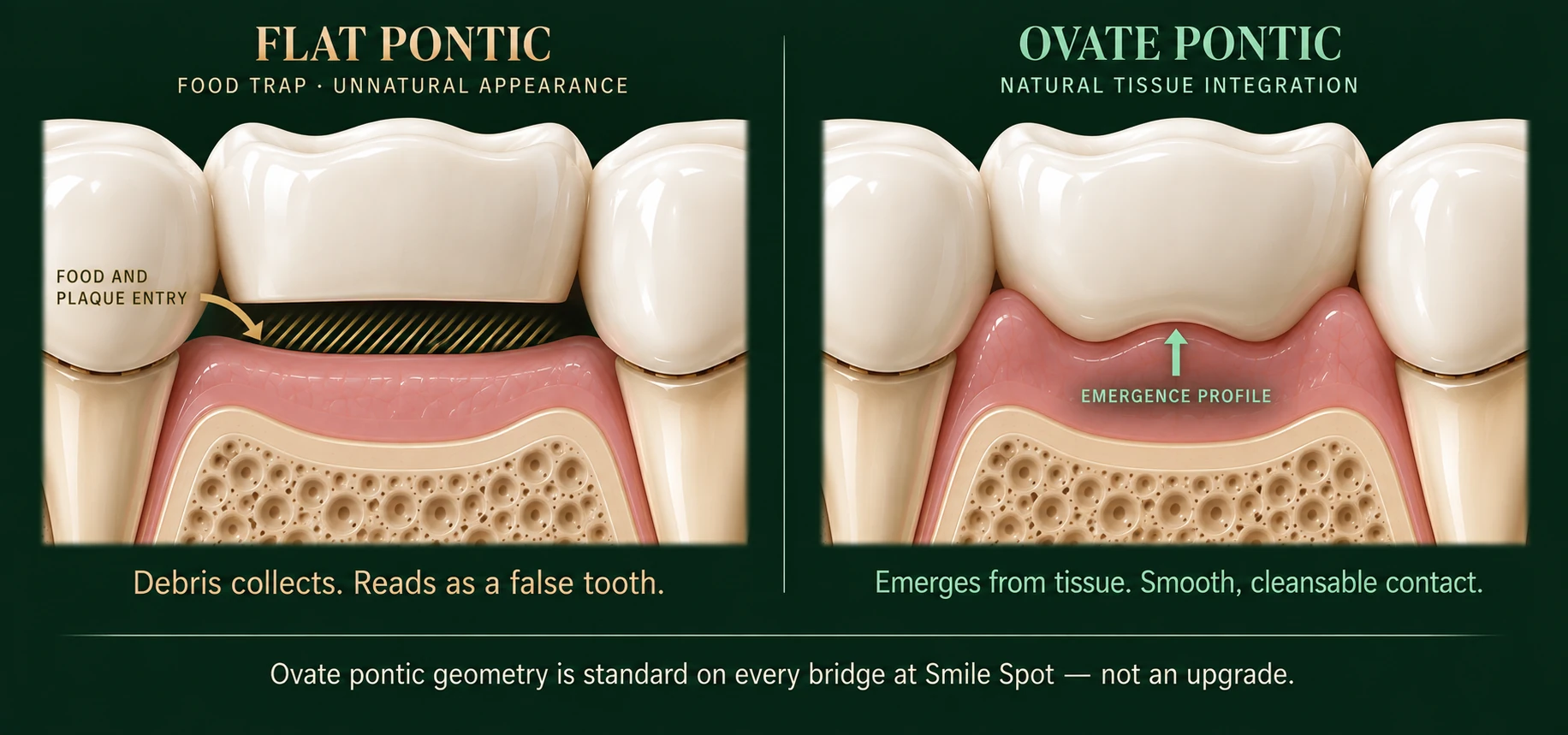 Cross-section comparison of two pontic designs — a flat-bottomed pontic hovering above the ridge with an open gap beneath it where food and plaque collect, and an ovate pontic pressed into a shaped concavity in the gum so the tooth appears to emerge from the tissue with a smooth, cleansable contact — Smile Spot Dentistry, Venice FL