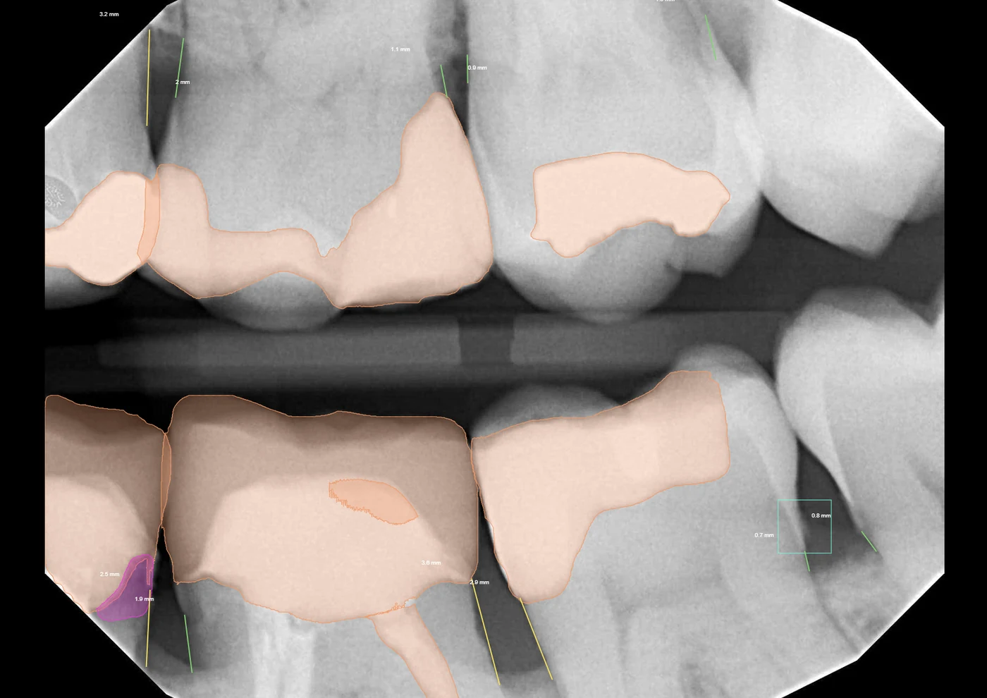Pearl AI annotated bitewing radiograph highlighting restorations, pulp and bone levels — Smile Spot Dentistry Venice, Florida