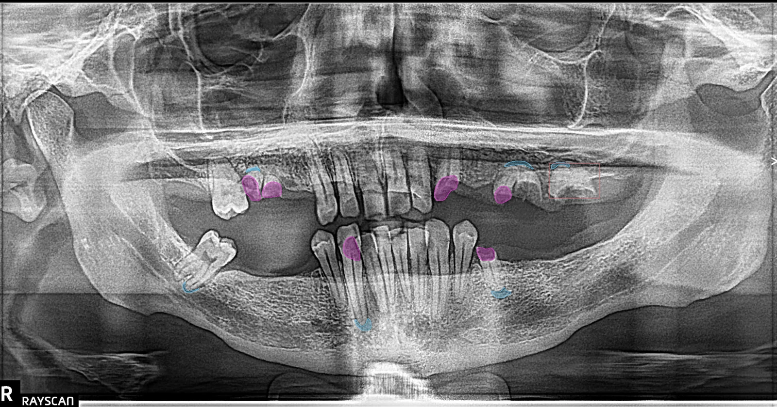 Pearl AI findings overlaid on a panoramic radiograph at Smile Spot Dentistry, Venice FL