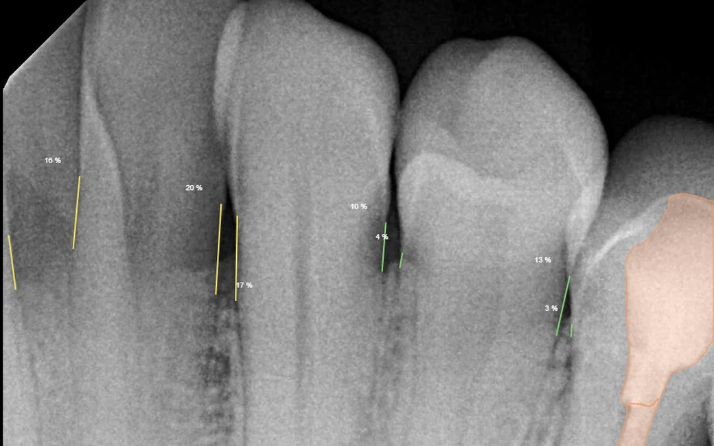 Pearl AI overlay marking bone levels and a restoration on a dental radiograph