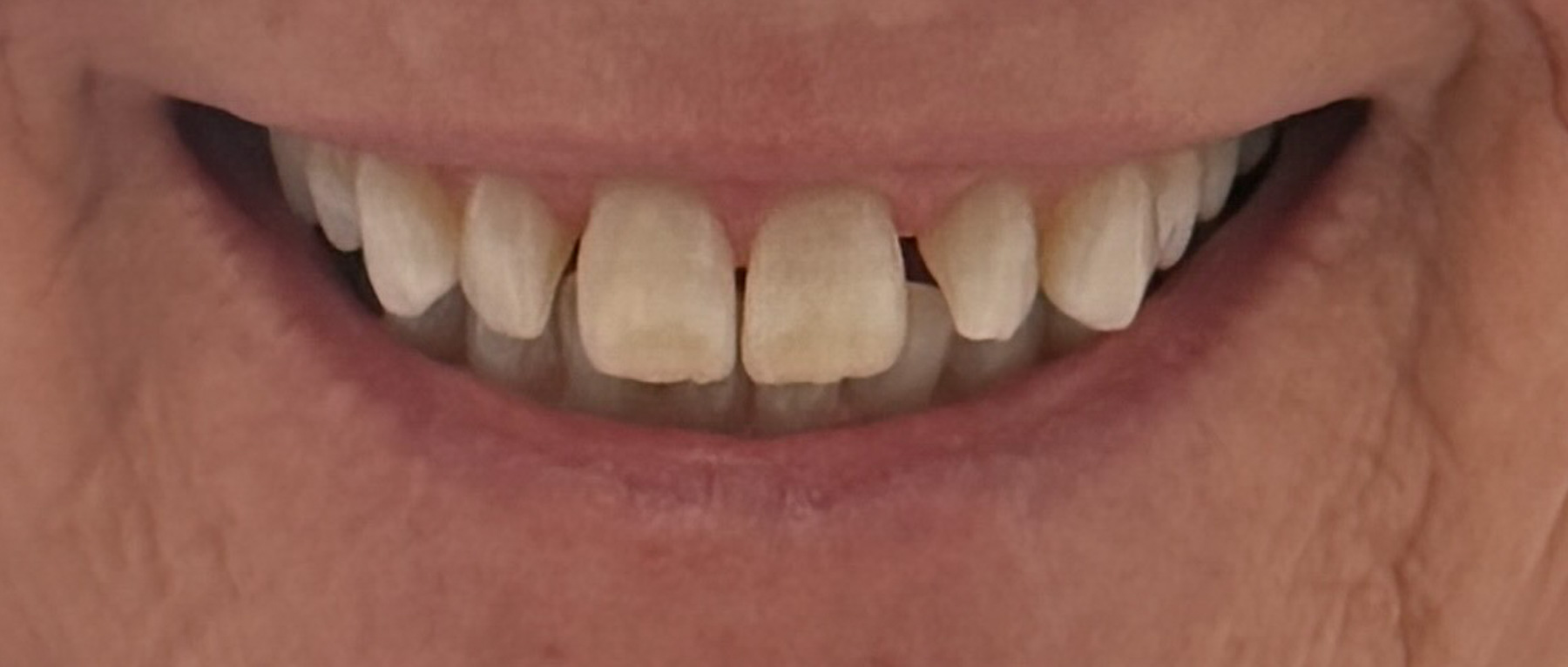 Before treatment — worn, discolored upper front teeth