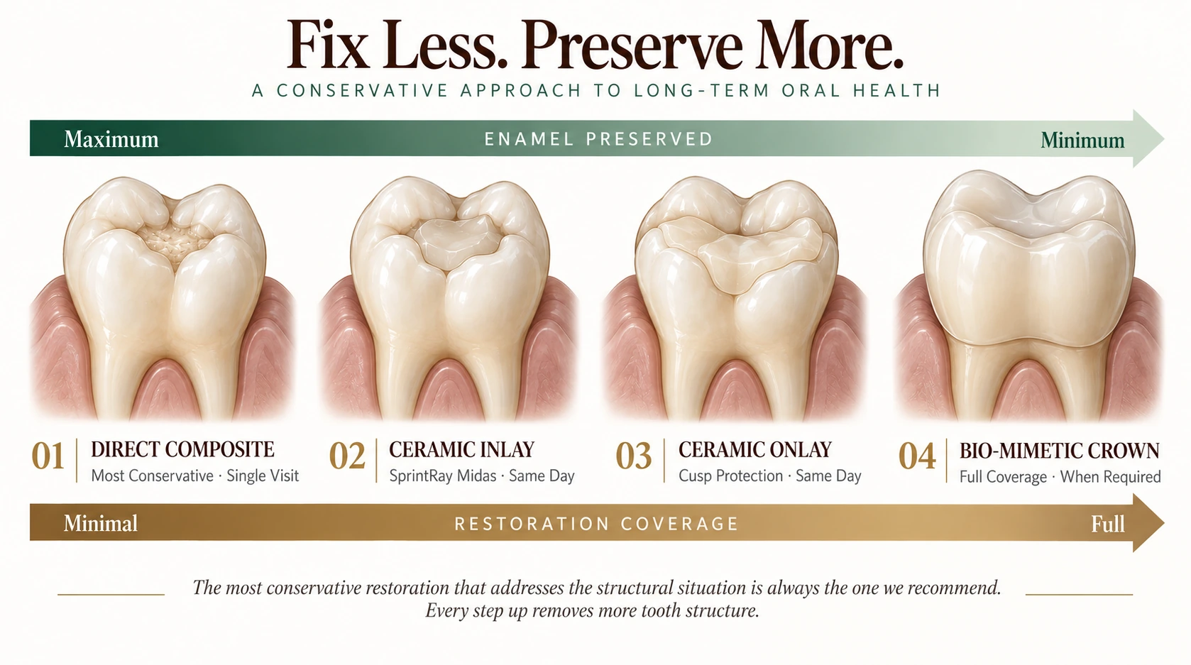 Restoration hierarchy at Smile Spot Dentistry, Venice FL — direct composite, ceramic inlay, ceramic onlay, and bio-mimetic crown, showing how enamel preserved decreases as restoration coverage increases