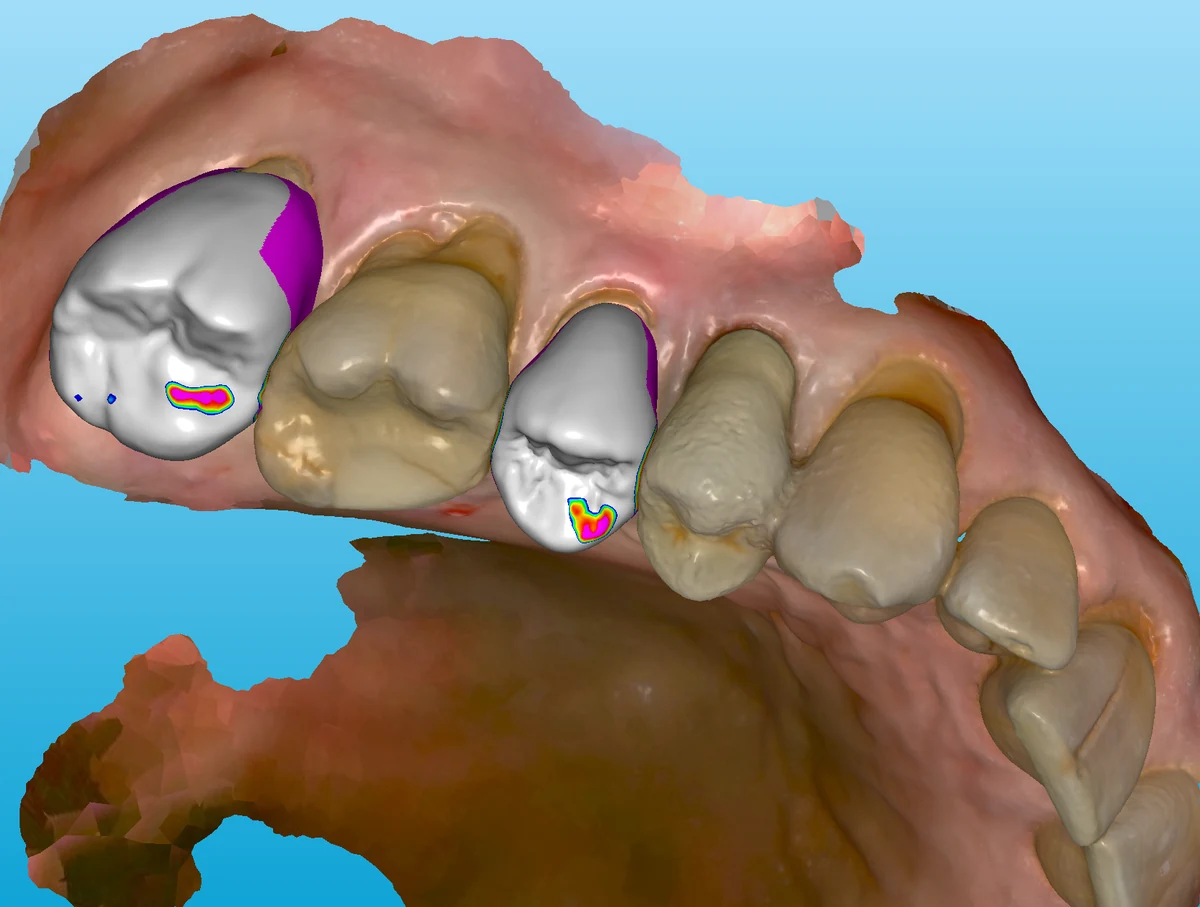 Restoration planning — crowns designed on the digital scan with contacts mapped on screen, Smile Spot Dentistry, Venice FL