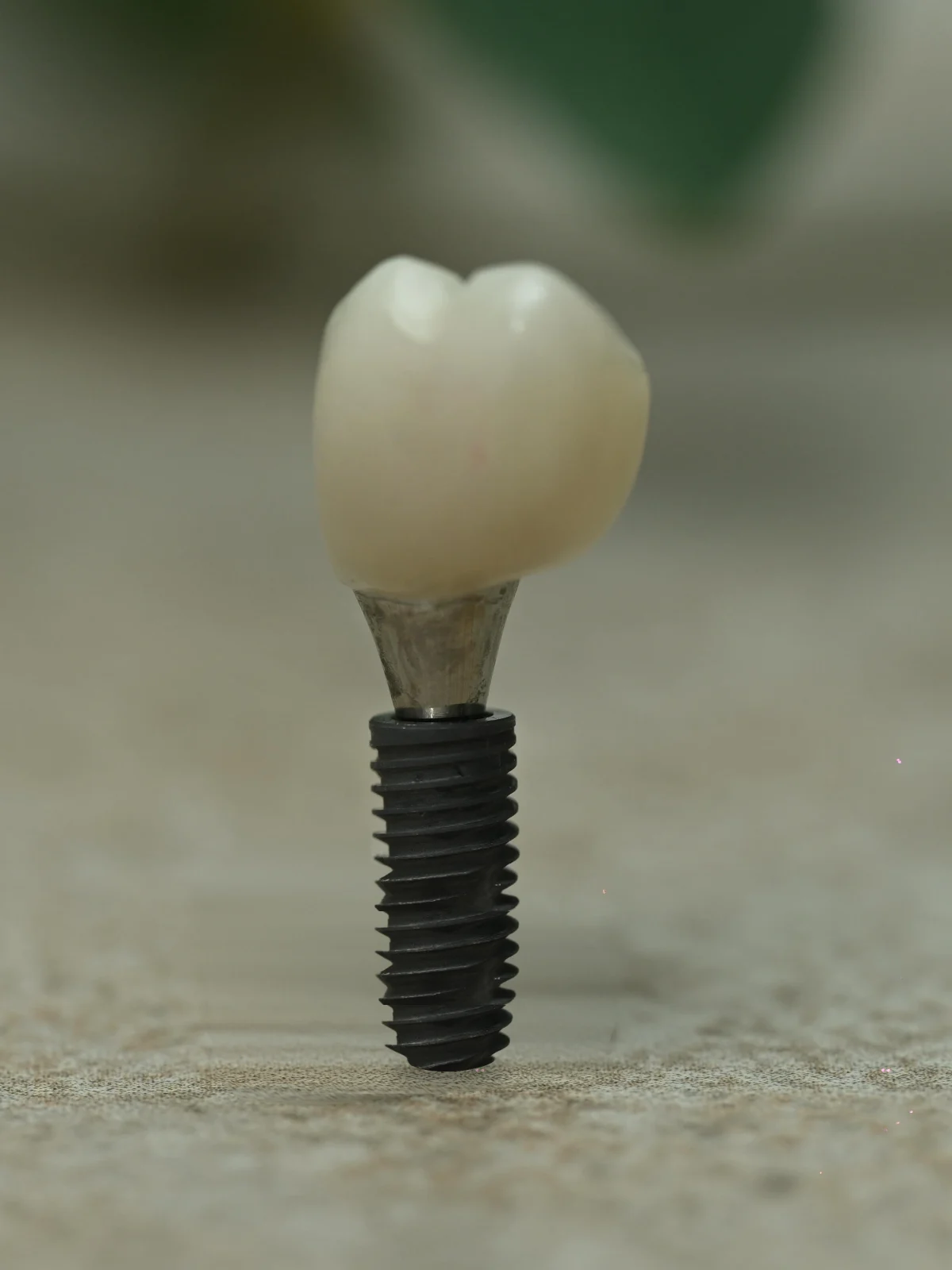 Single tooth dental implant with porcelain crown — Smile Spot Dentistry, Venice, FL