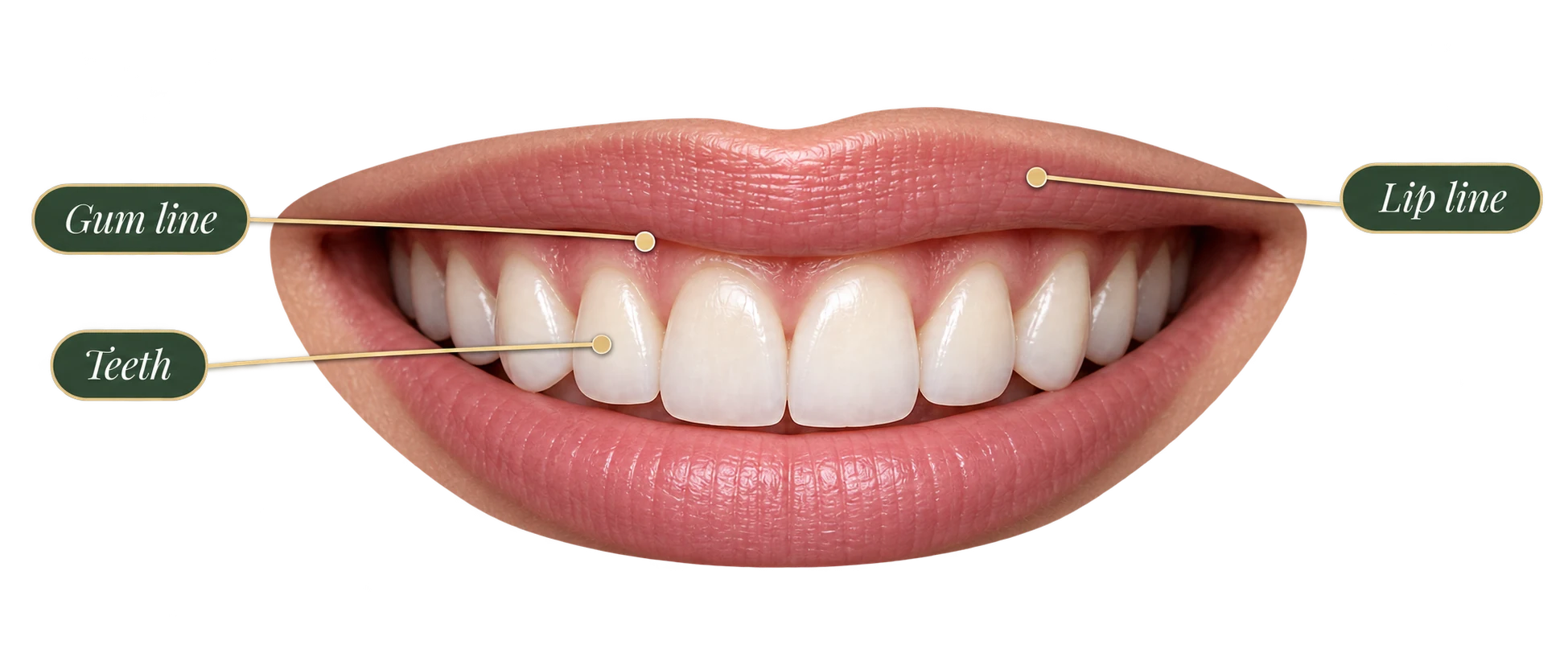 Close-up smile labelled to show the three elements of smile architecture: the teeth, the gum line and the lip line