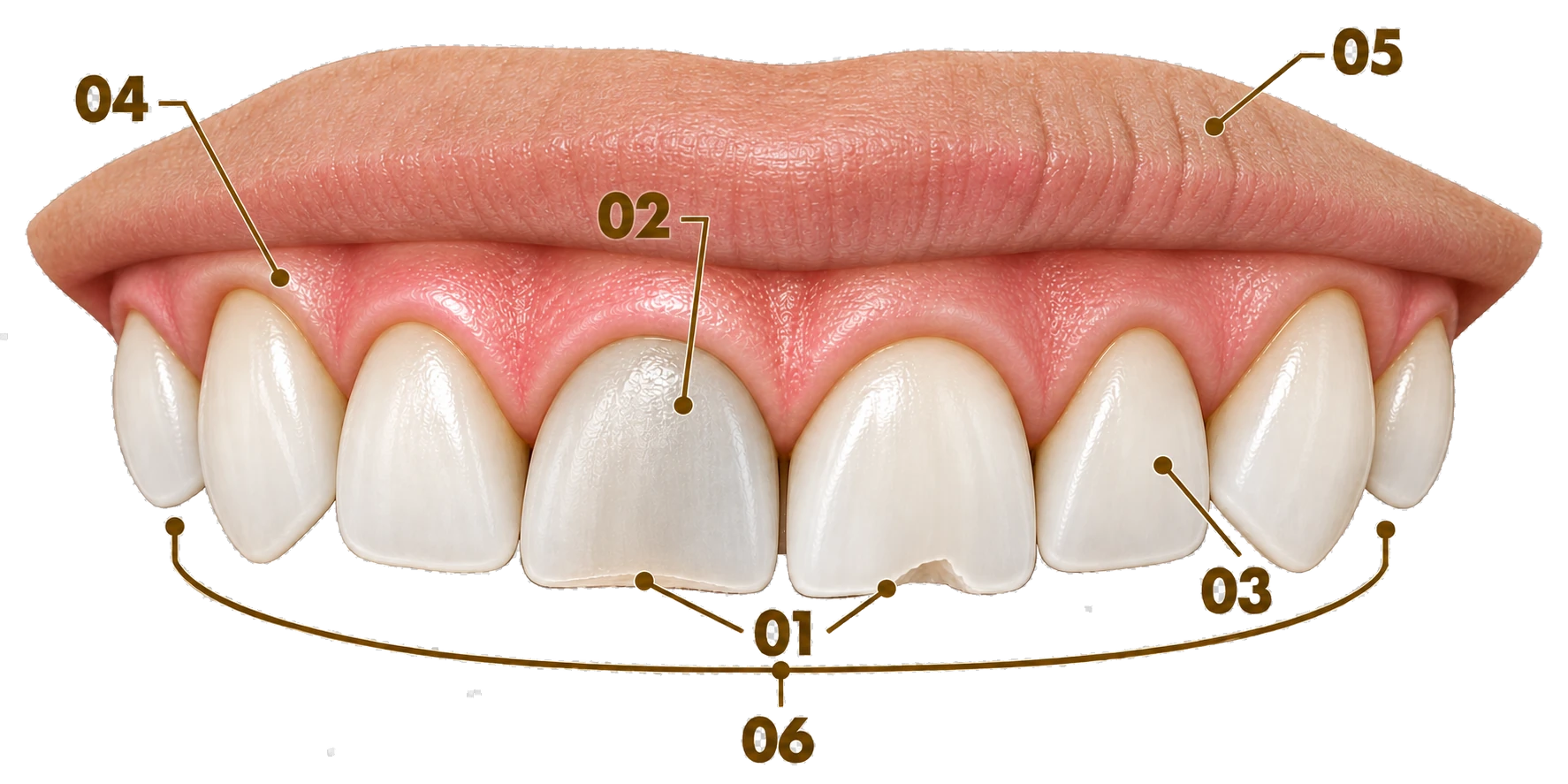 Six common cosmetic concerns marked on a single smile — worn edges, intrinsic discoloration, asymmetry, an irregular gumline, chips and gaps, and an aged smile — Smile Spot Dentistry, Venice, FL