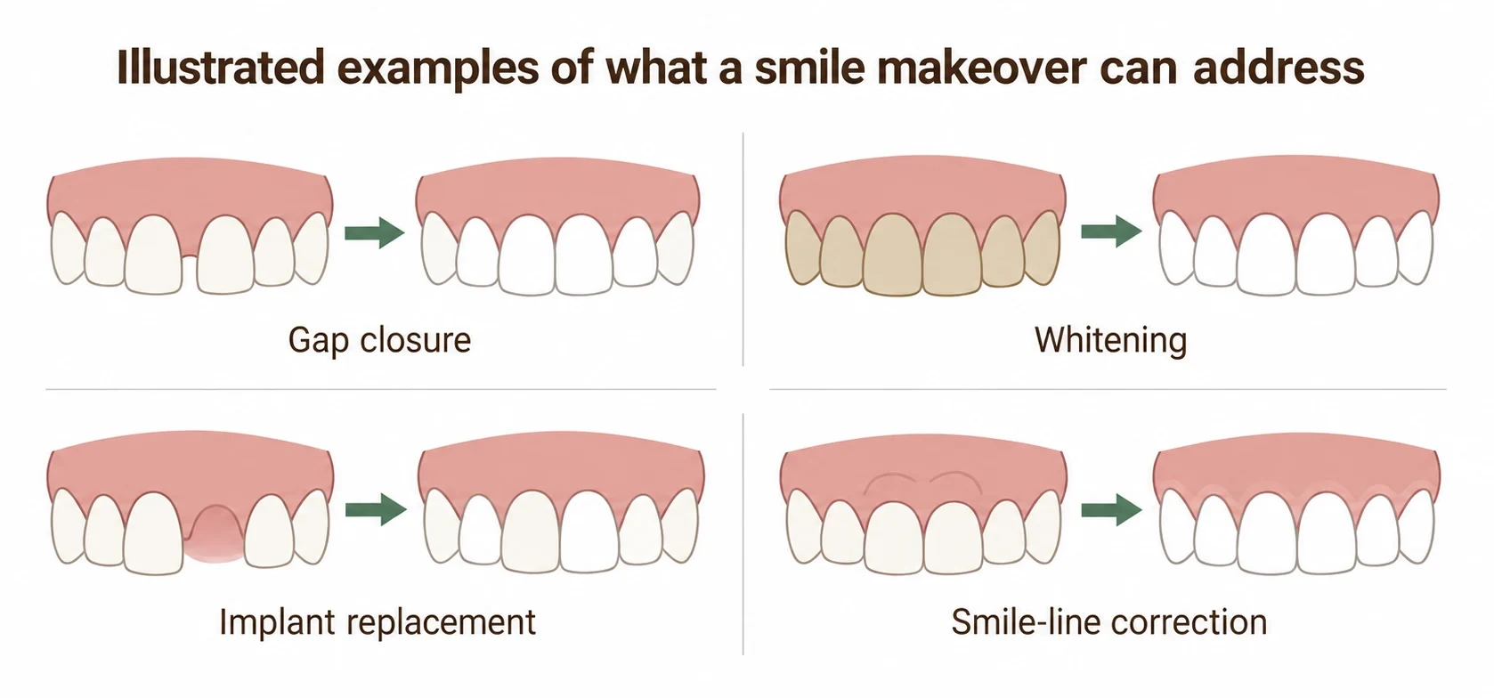 Illustrated examples of what a smile makeover can address — gap closure, whitening, implant replacement and smile-line correction