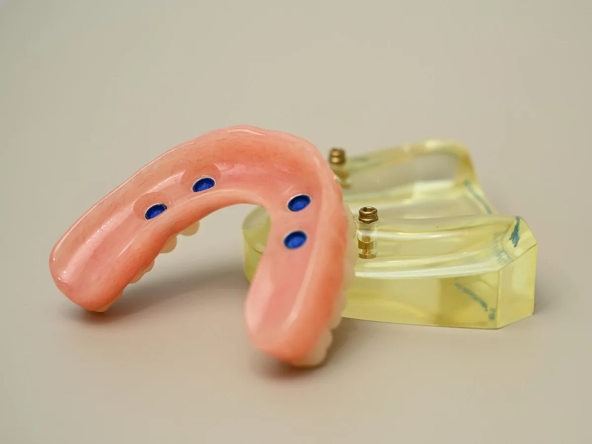 Snap-in implant-retained overdenture — Smile Spot Dentistry, Venice FL