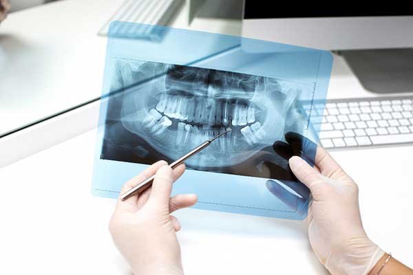 Dental-Implants